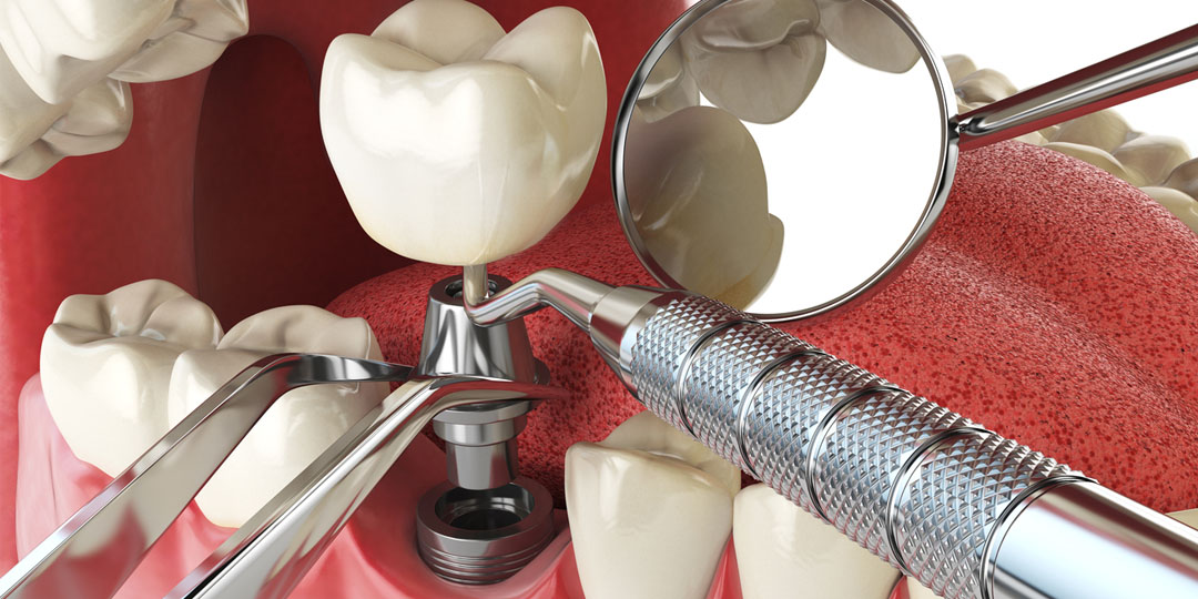 Стоматология Артдентал - Имплантация зубов немецкими имплантами