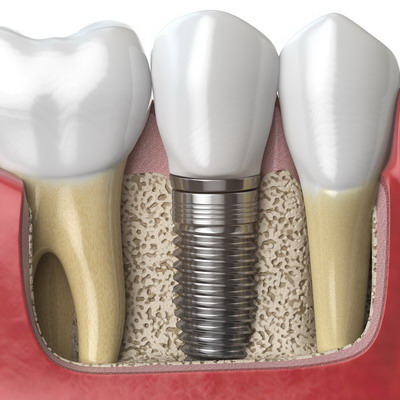 Внешний вид зубов после инплантации