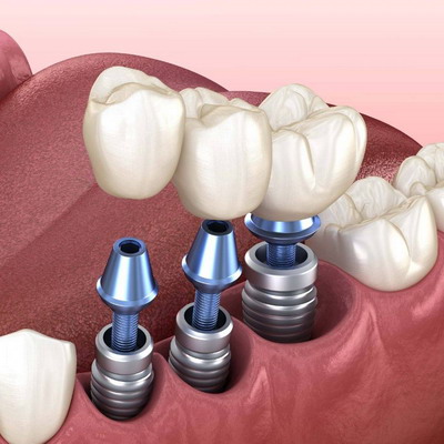 Имплантация зубов - механизм установки импланта