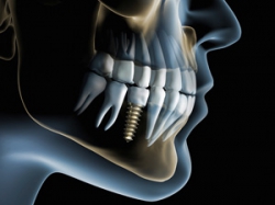 Костная пластика зубов при имплантации