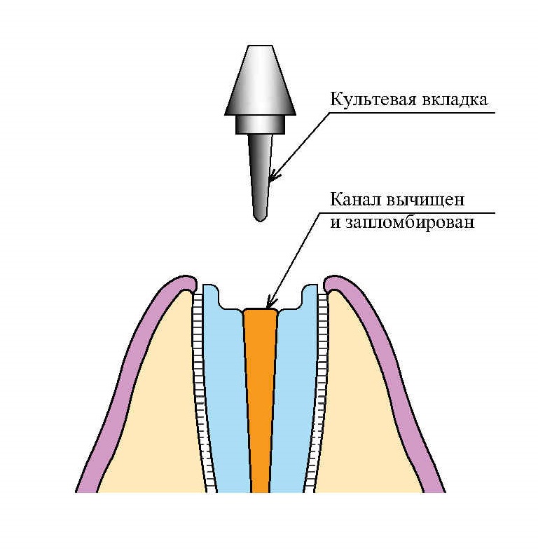 Несъемные зубные протезы - культевая вкладка в канал