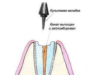 Несъемные зубные протезы - культевая вкладка в канал