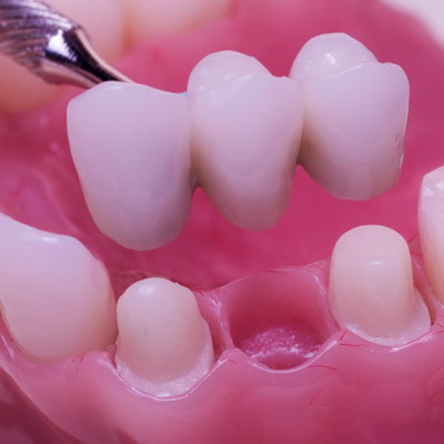 Подбор винира по цвету при протезировании зуба