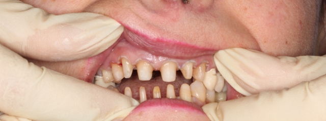 Стадии протезирования зубов
