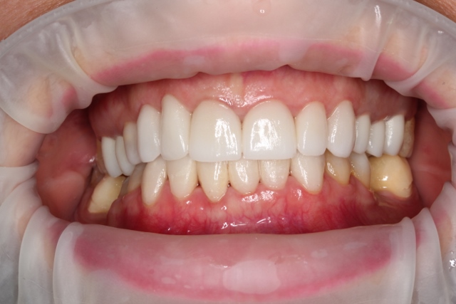 Стадии протезирования зубов