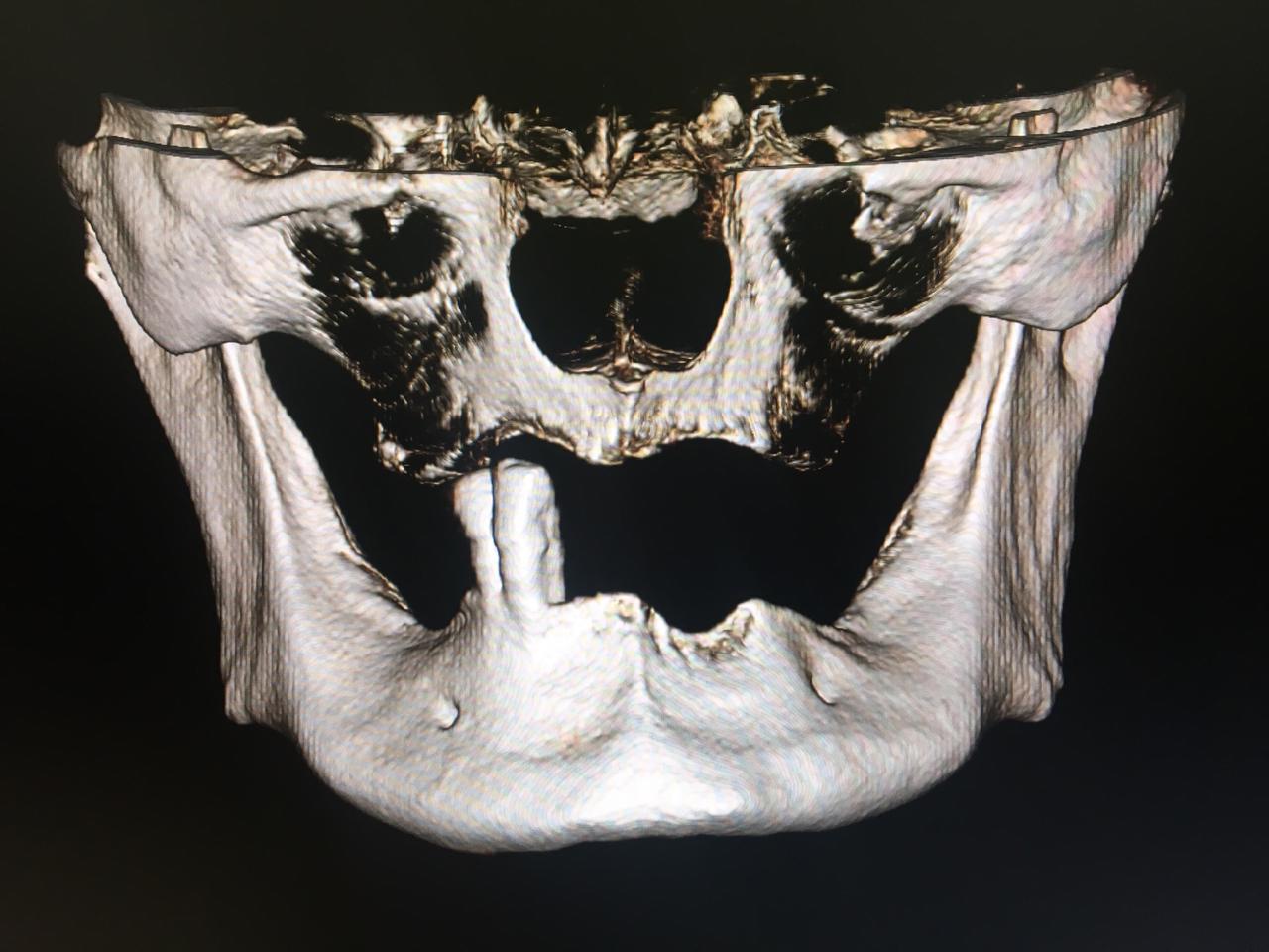 Тотальная имплантация обеих челюстей