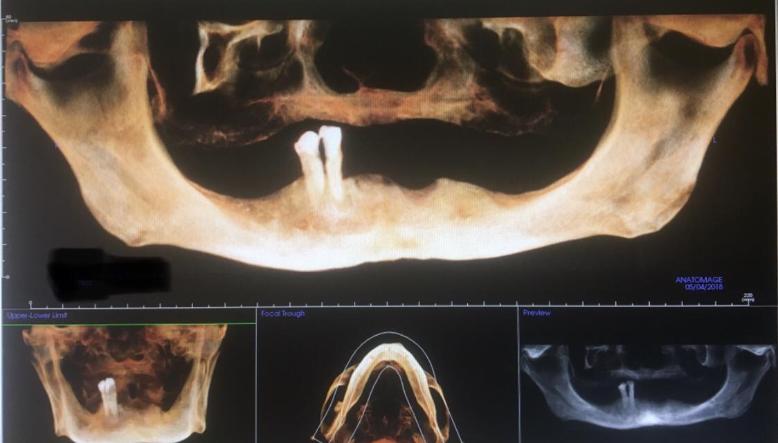 Тотальная имплантация обеих челюстей