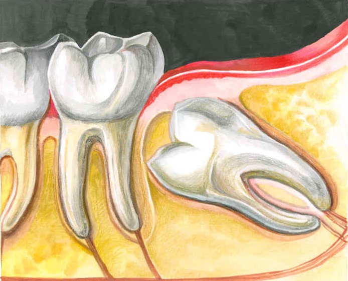 Удаление зуба мудрости