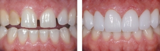 Ряд зубов до установки виниров (родные) и после
