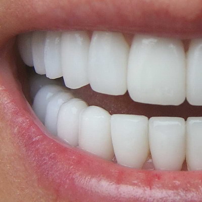 Нейлоновый зубной протез на заднюю часть верхней челюсти